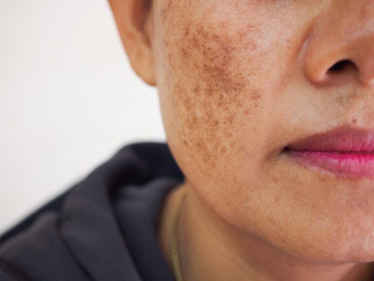 pico-laser-for-pigmentation