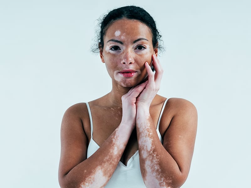 pigmentation-treatment