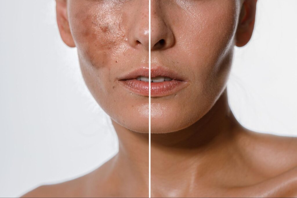 pigmentation-treatment