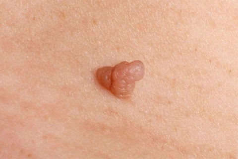 skin tag removal kuala lumpur