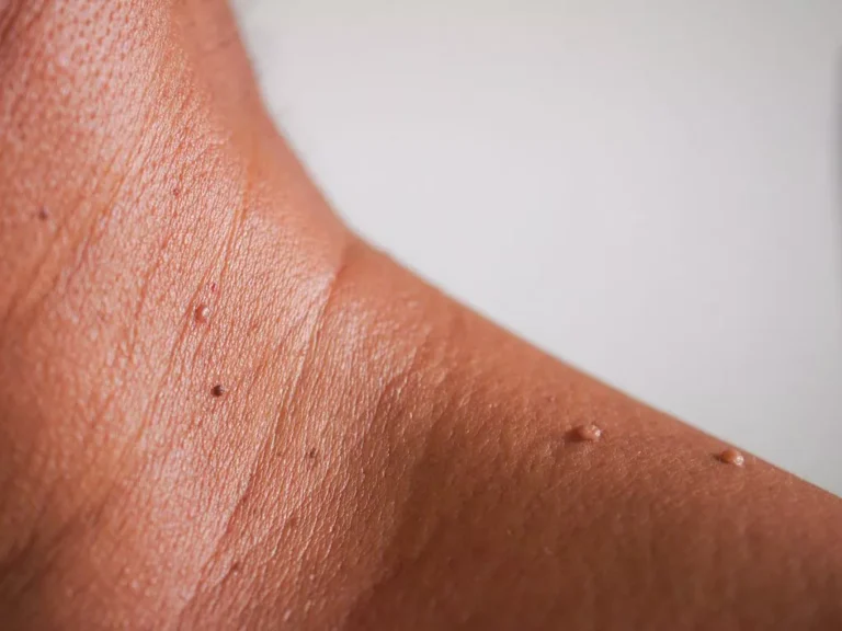 skin tag removal malaysia