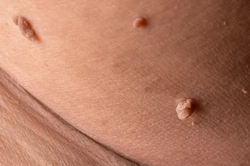 skin-tag-removal-malaysia-near-me
