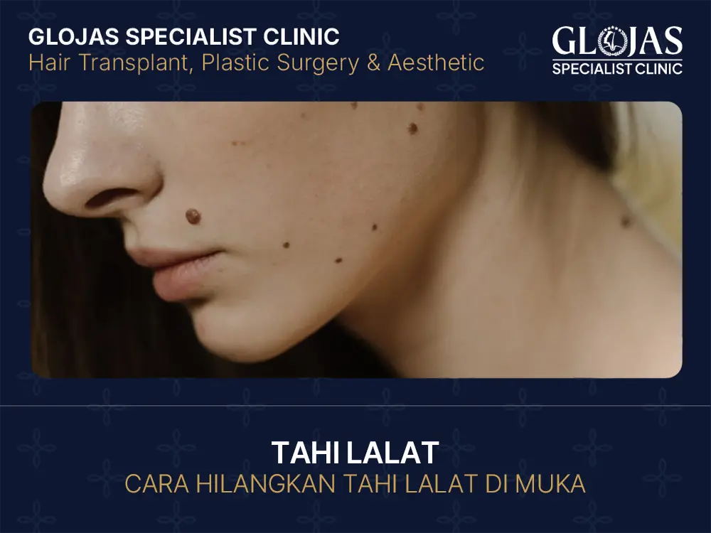Cara Hilangkan Tahi Lalat Di Muka, Penyebab & Jenis Tahi Lalat (2025)