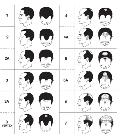 Thinning Hair: Causes, Treatments, and Effective Hair Regrowth Solutions 2 thinning-hair-male-pattern-baldness