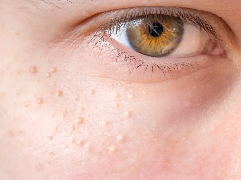 tiny-bumps-cara-hilangkan