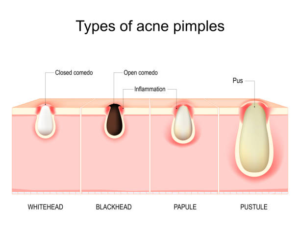 Whiteheads: Causes, Treatment & How to Prevent Acne Bumps Effectively 3 types-of-acne-whiteheads