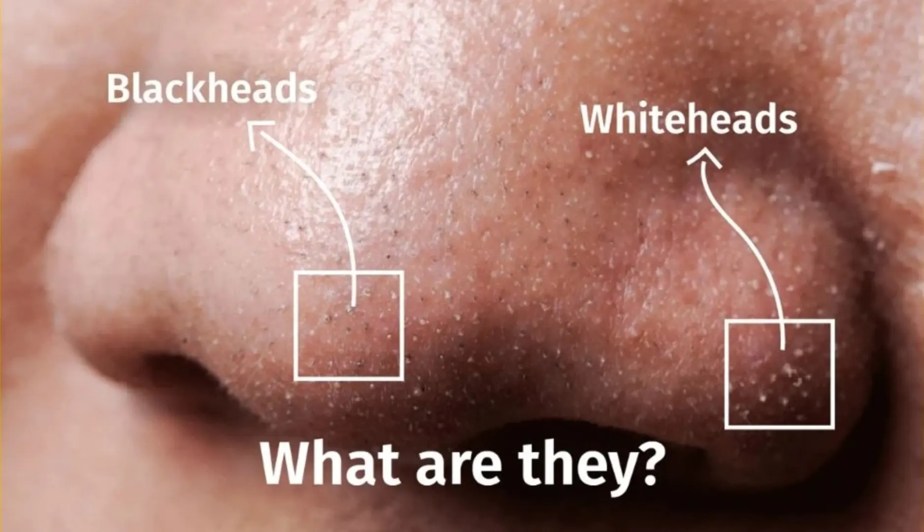 Whiteheads: Causes, Treatment & How to Prevent Acne Bumps Effectively 1 whiteheads