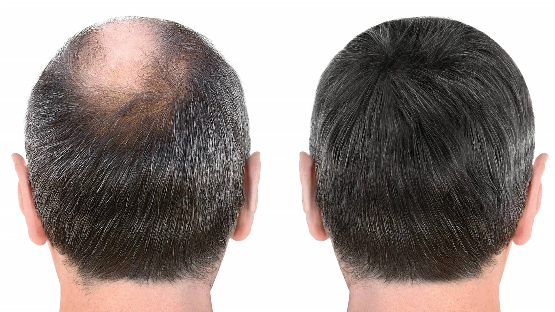 Dutasteride vs Finasteride: Which One Is Stronger as a DHT Blocker? 2 Dutasteride vs Finasteride-hair-regrowth-dht-blocker