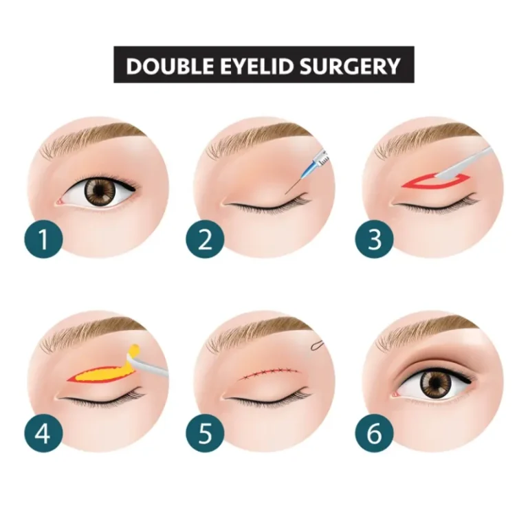 blepharoplasty-eyelid-surgery-malaysia