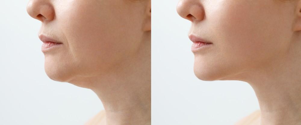 5 Effective Treatments to Get Rid of Double Chin in 2025 1 double-chin-treatment-malaysia