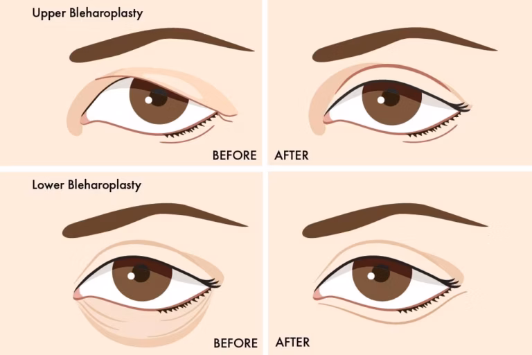double eyelid surgery blepharoplasty