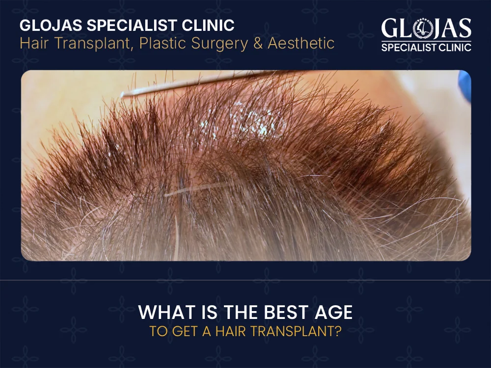 hair-transplant-age