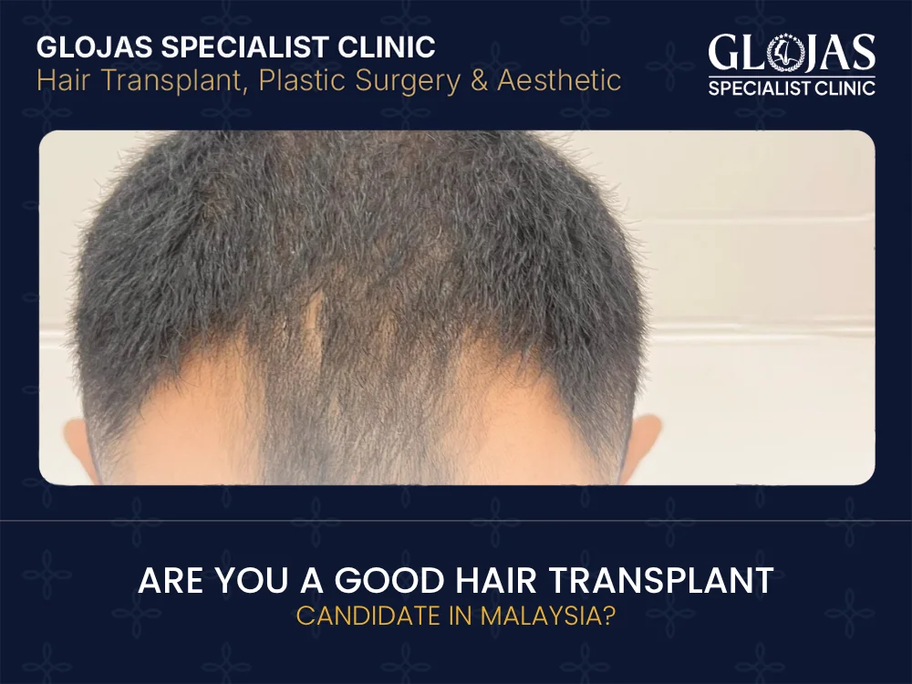 hair-transplant-candidate