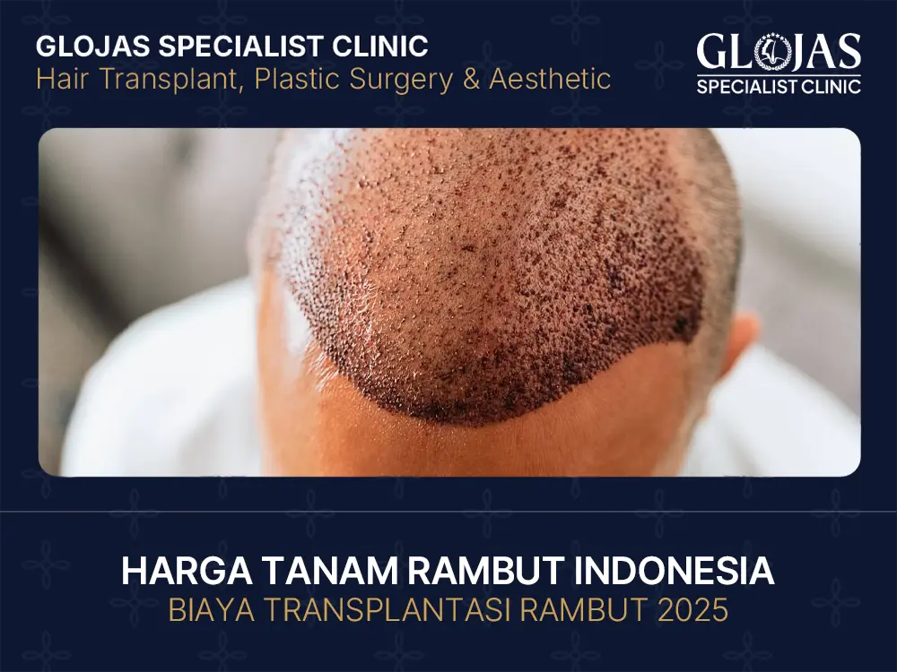 Harga Tanam Rambut Indonesia | Biaya Transplantasi Rambut 2025 1 harga-tanam-rambut-indonesia-biaya-transplantasi-rambut