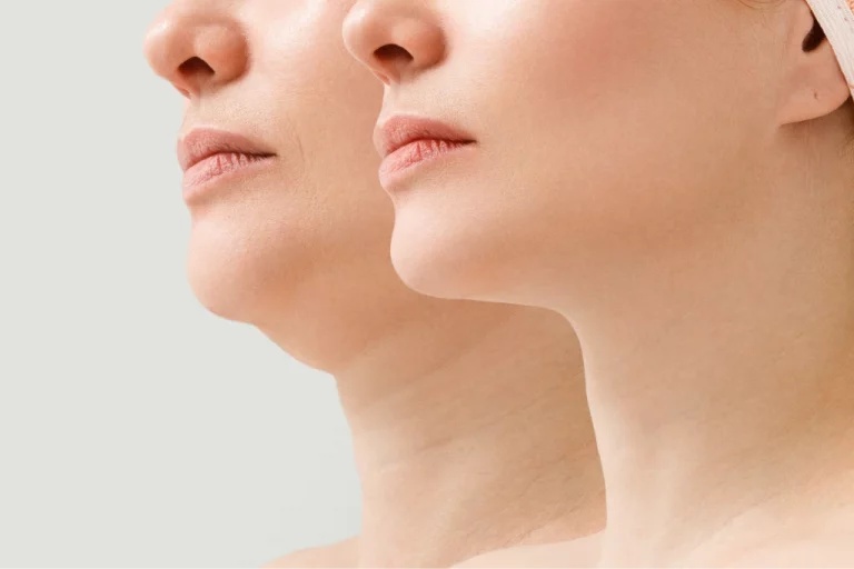 5 Effective Treatments to Get Rid of Double Chin in 2025 2 how-to-get-rid-of-double-chin-malaysia