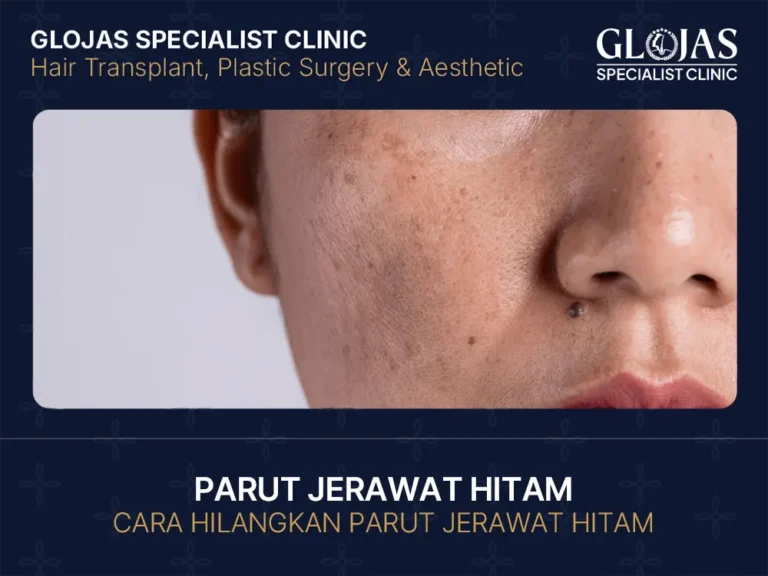 parut-jerawat-hitam