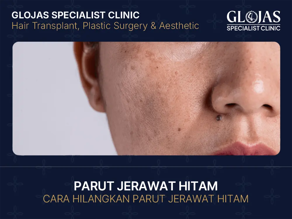 Petua & Cara Hilangkan Parut Jerawat Hitam Dengan Cepat