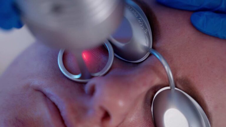 Fractional CO2 Laser Treatment for Skin Resurfacing & Renewal