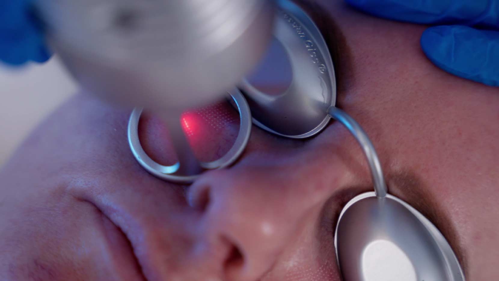 Furrowed Brow fractional co2 laser