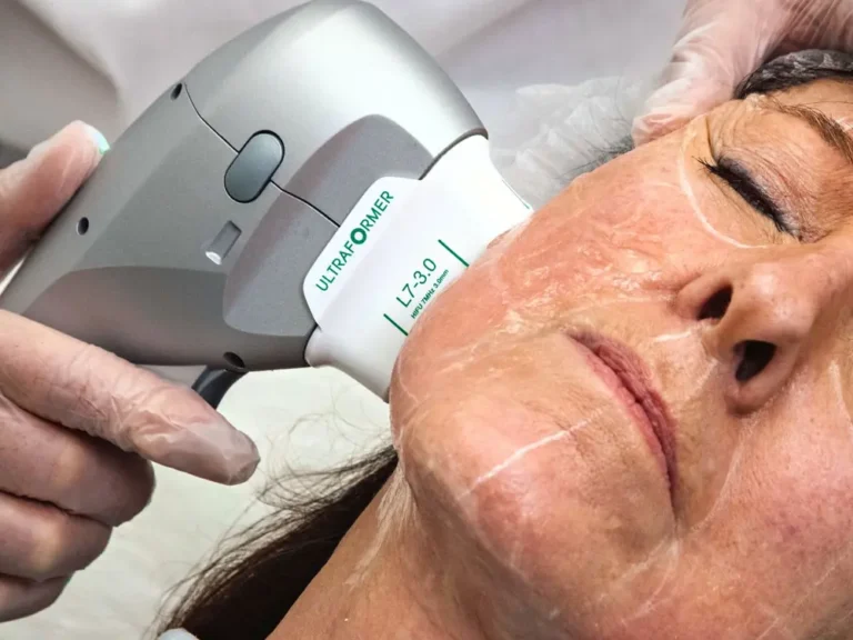 V Shape Face Treatment 5 HIFU-v-shape