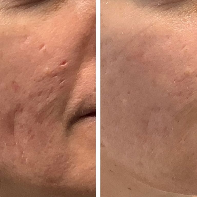 acne-scar-treatment-subcision