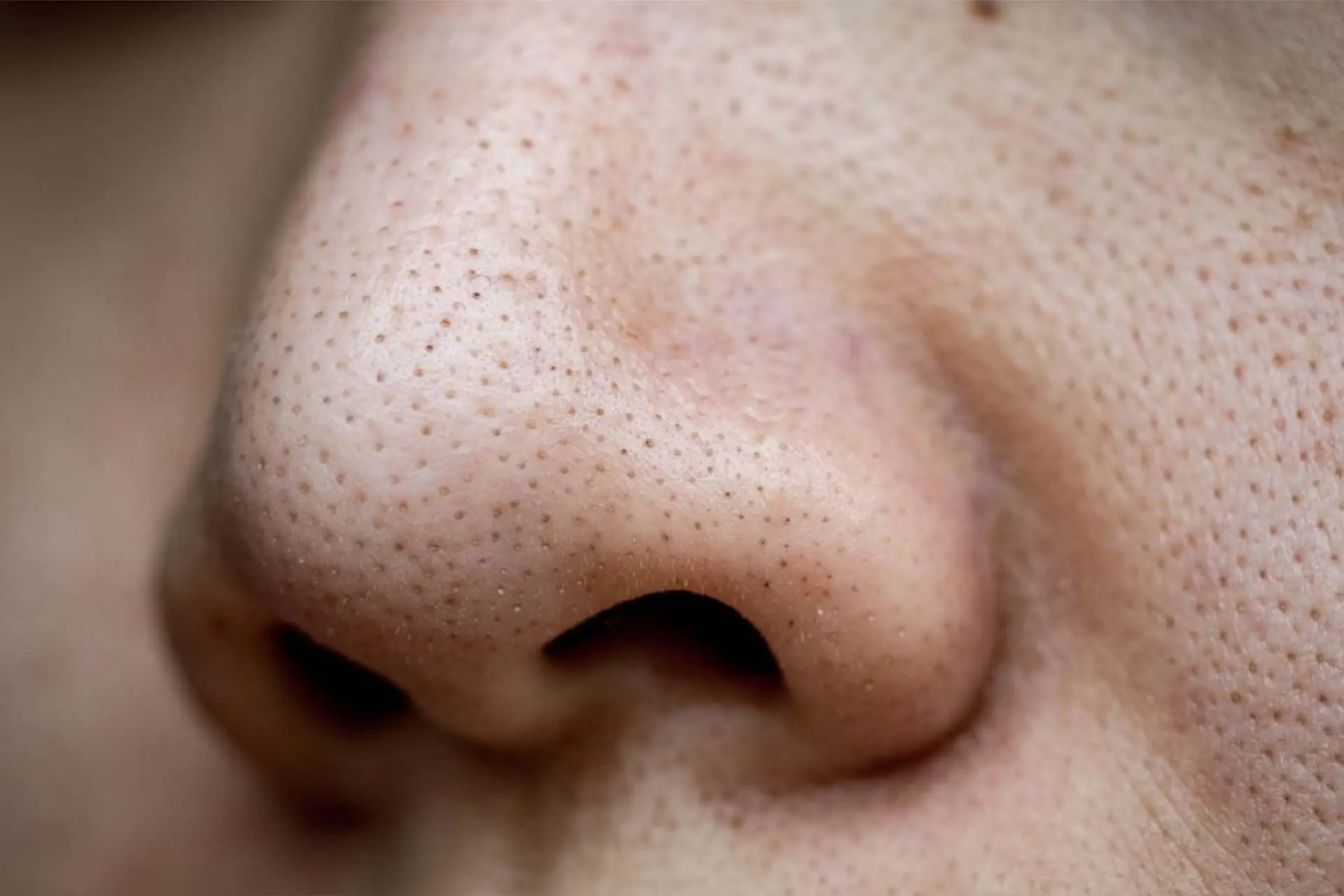 12 Cara Hilangkan Blackheads Dengan Berkesan Untuk Kulit Licin (2025) 1 cara-hilangkan-blackheads