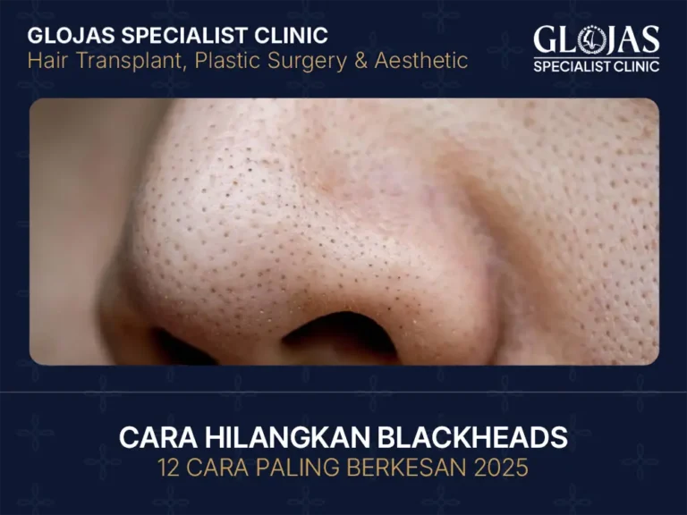 cara-hilangkan-blackheads