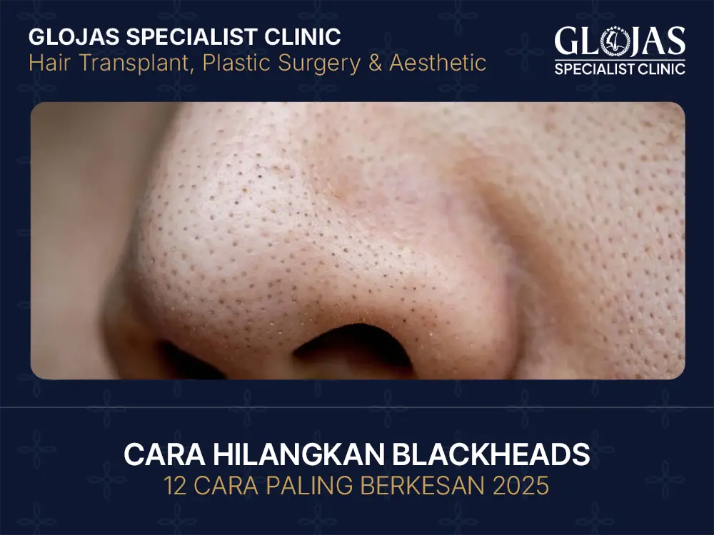 cara-hilangkan-blackheads