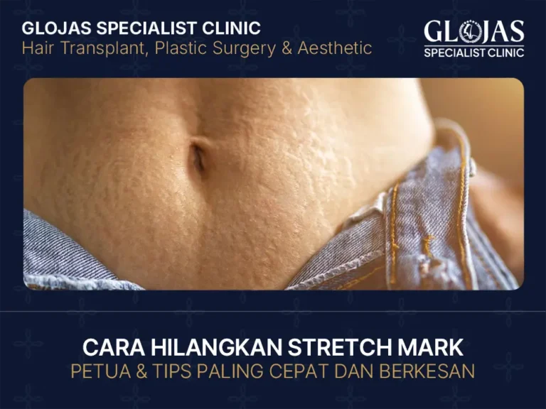 cara-hilangkan-stretch-mark