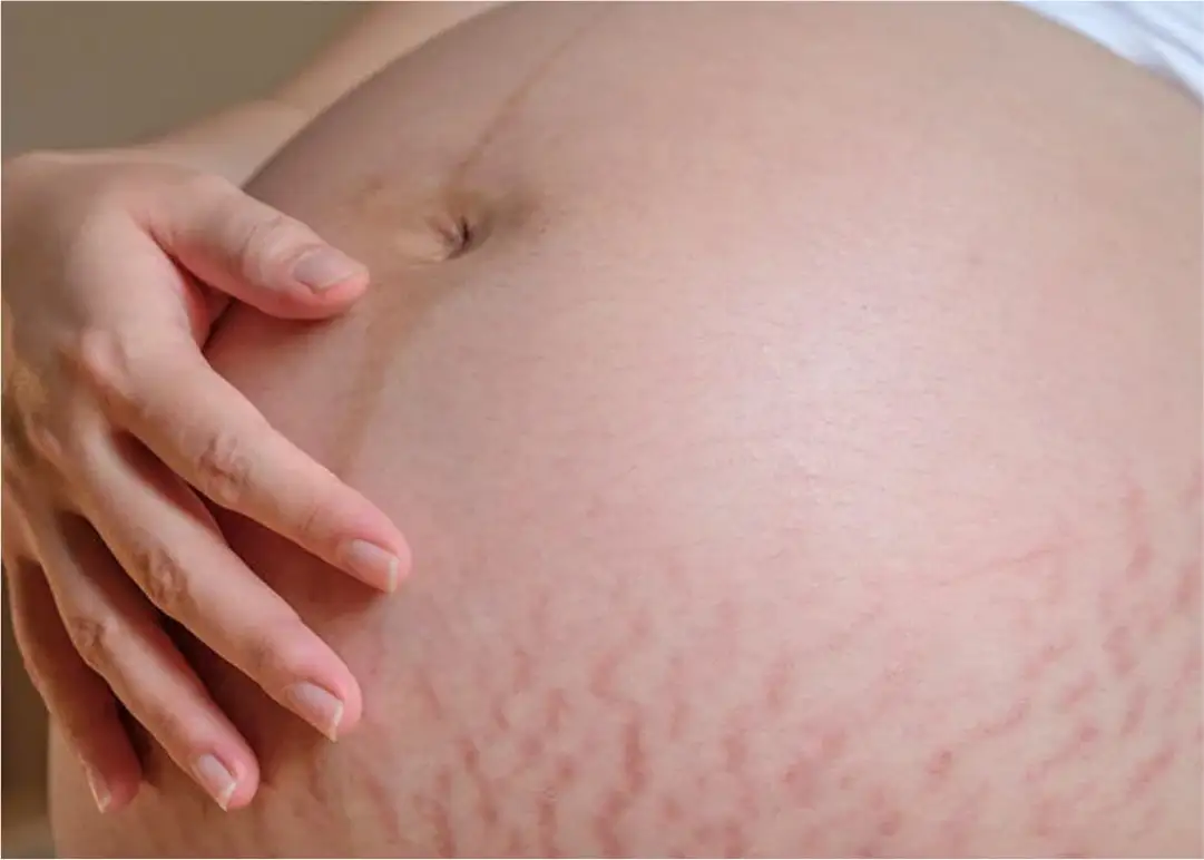 cara-hilangkan-stretch-mark-ibu-mengandung