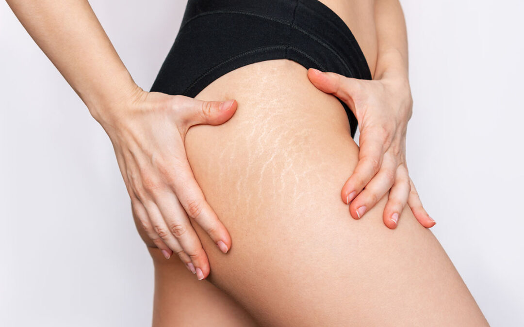 cara-hilangkan-stretch-mark