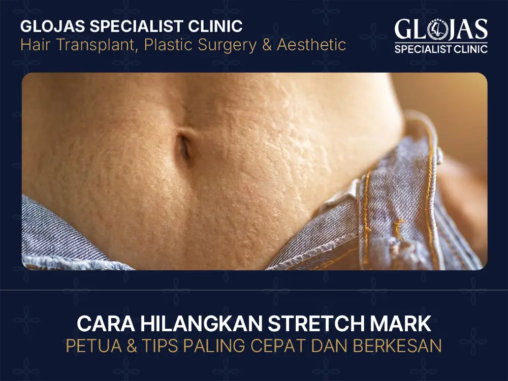 cara-hilangkan-stretch-mark