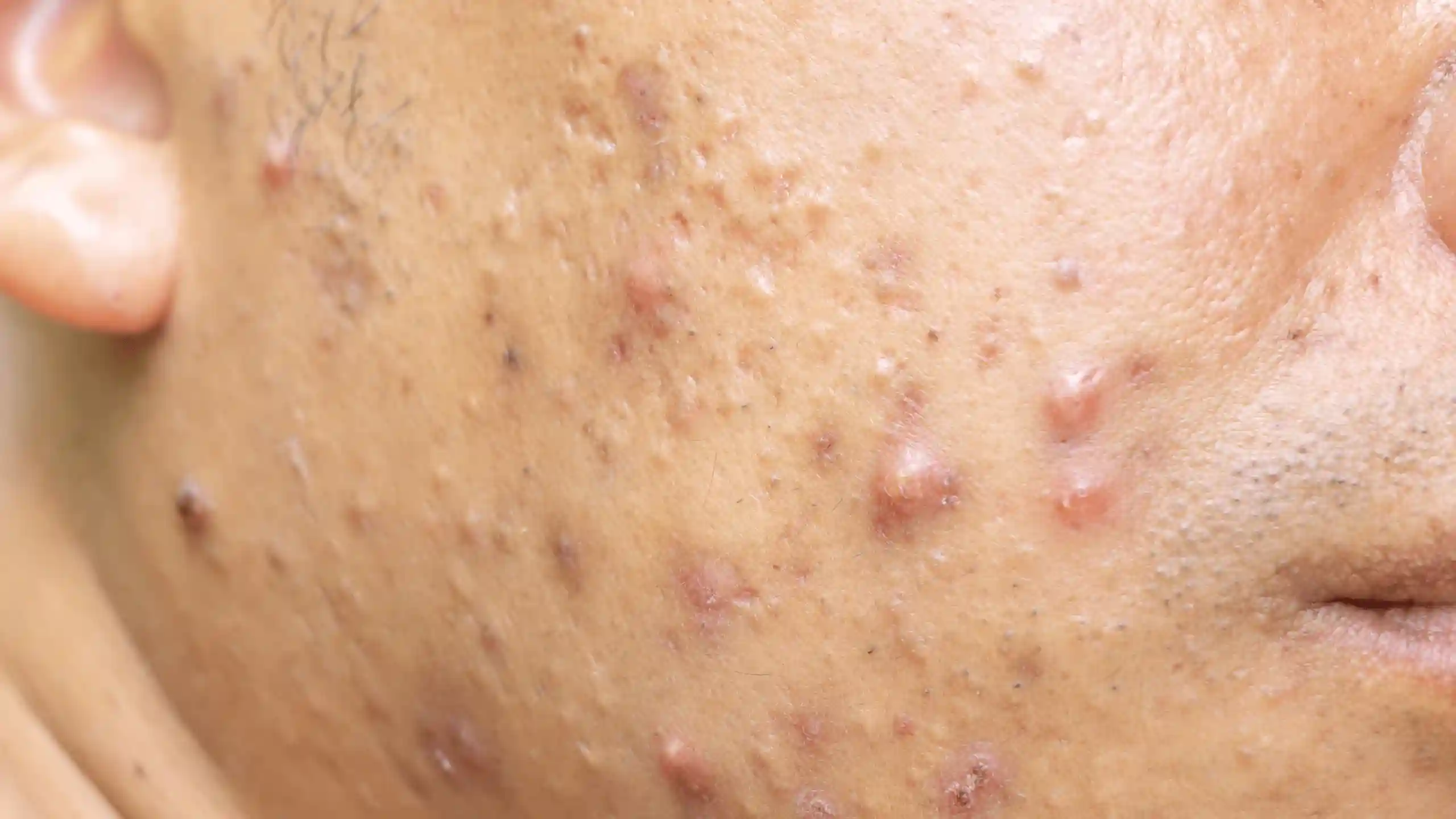 Cystic Acne: Causes, Symptoms & Expert-Approved Treatments 1 cystic-acne-treatment-malaysia