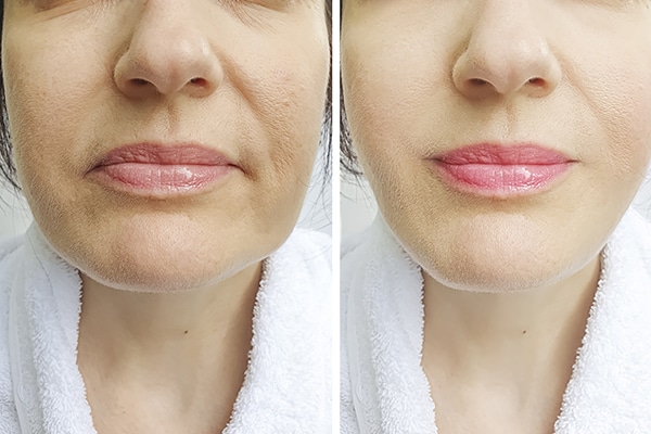 dermal-fillers-malaysia-before-after