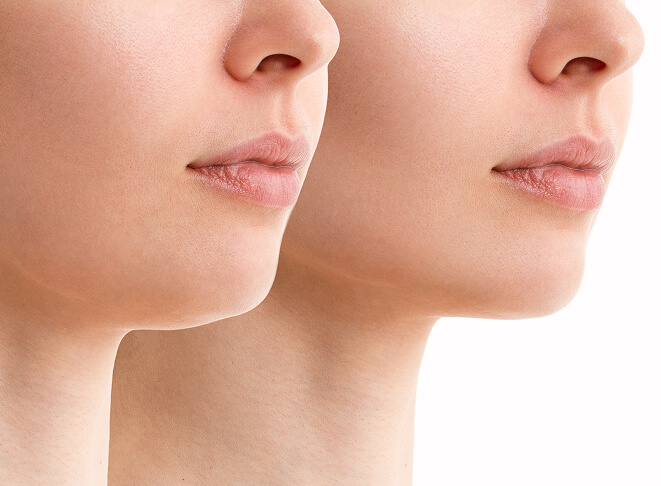 V Shape Face Treatment 7 v-shape-face-slimming