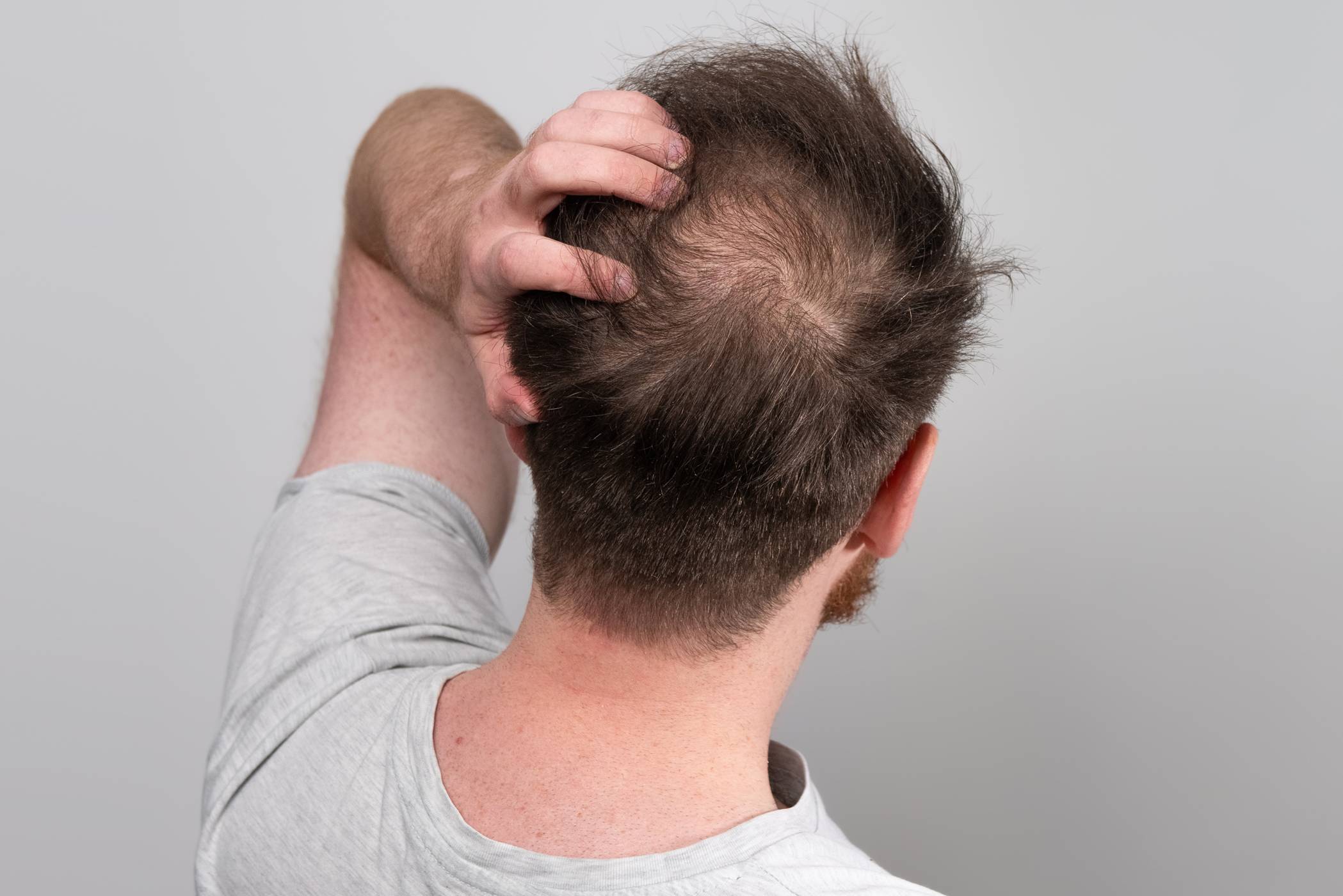 Ketoconazole Shampoo (Nizoral): Uses, Benefits & Side Effects 4 hair-thinning-Ketoconazole Shampoo