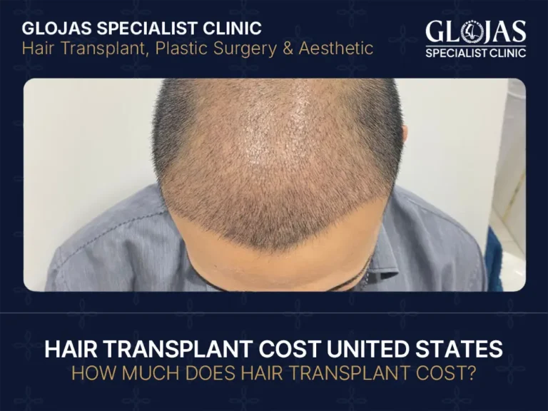 hair-transplant-cost-united-states