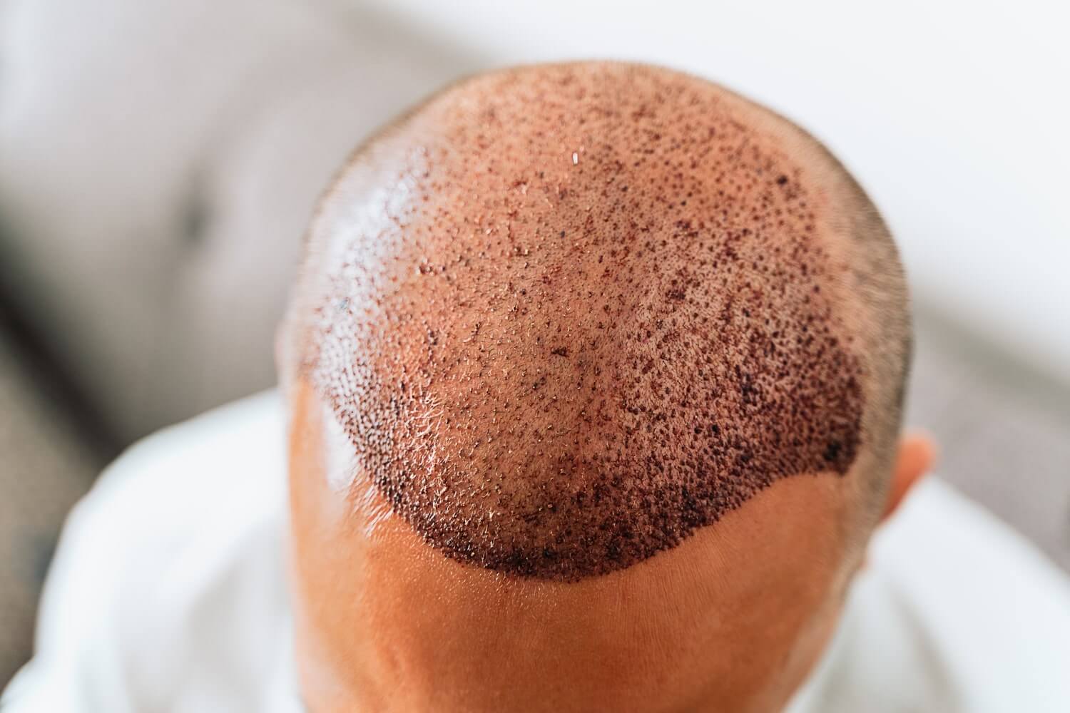 hair-transplant-cost-united-states