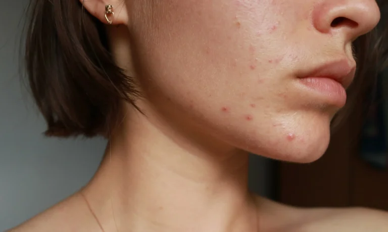Hormonal Acne: Causes, Symptoms & Effective Treatments