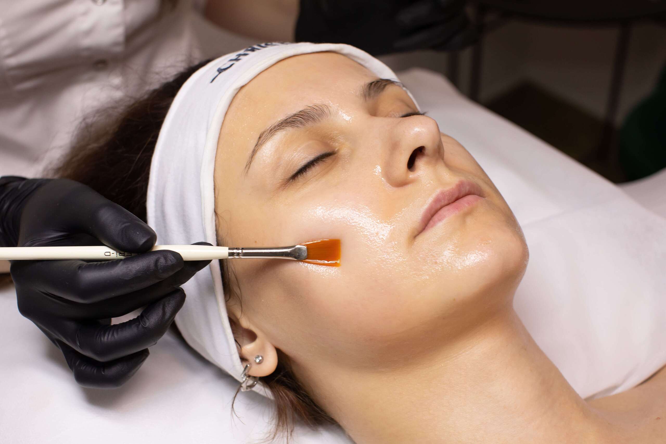hormonal-acne-chemical-peels-treatment-malaysia
