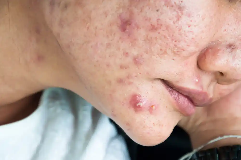 Cystic Acne: Causes, Symptoms & Expert-Approved Treatments 2 how-to-treat-cystic-acne
