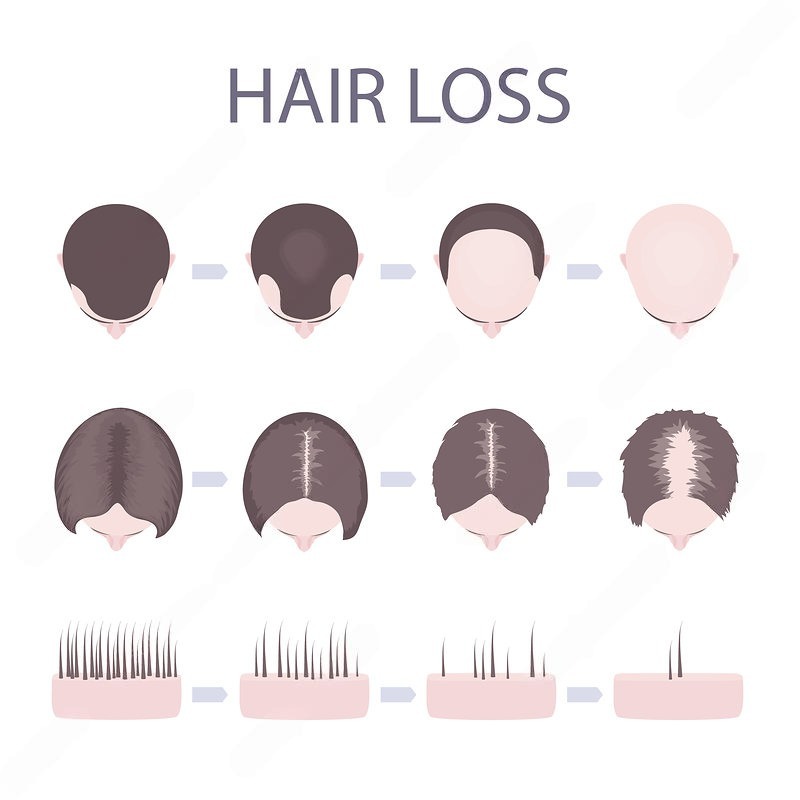 15 Punca Rambut Gugur Lelaki & Wanita Serta Rawatan Berkesan 1 rambut-gugur