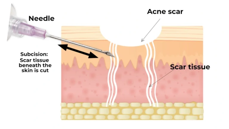 subcision procedure