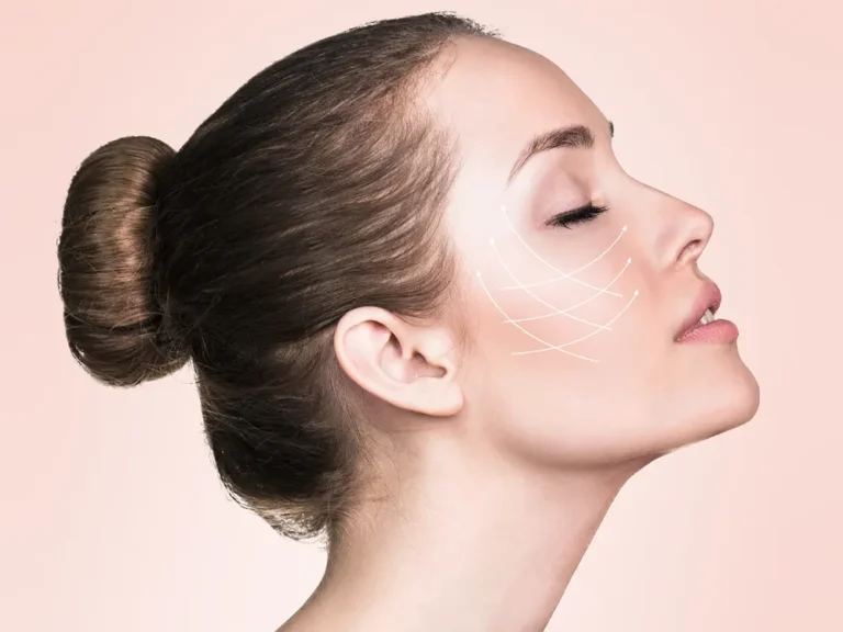 V Shape Face Treatment 6 thread lift v shape