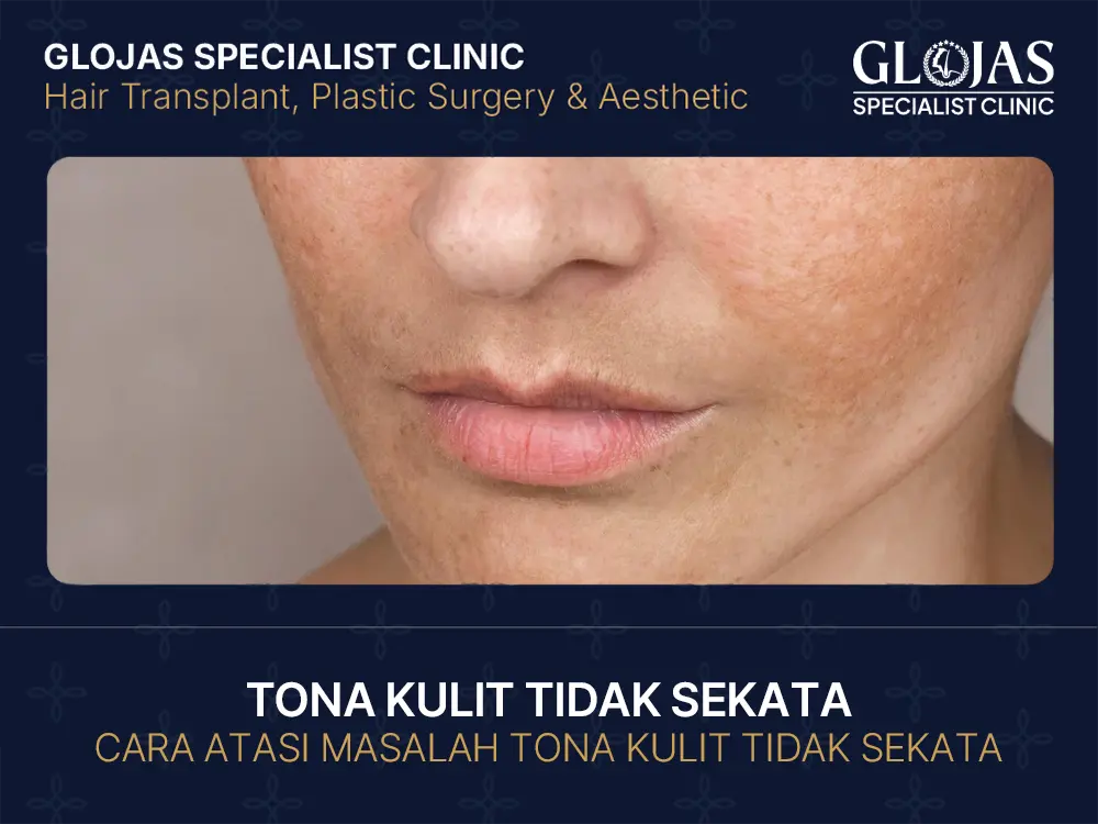 tona-kulit-tidak-sekata