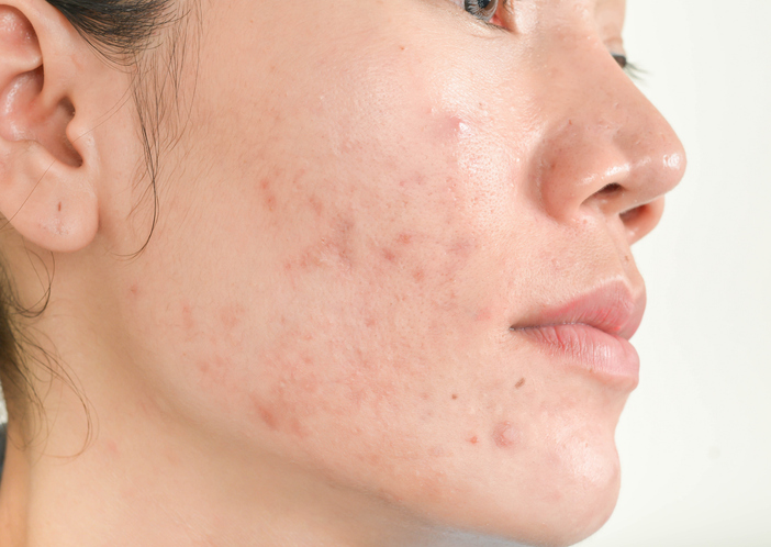 acne scar treatment candidate