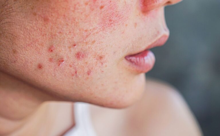 acne scar treatment for Hypertrophic Scars