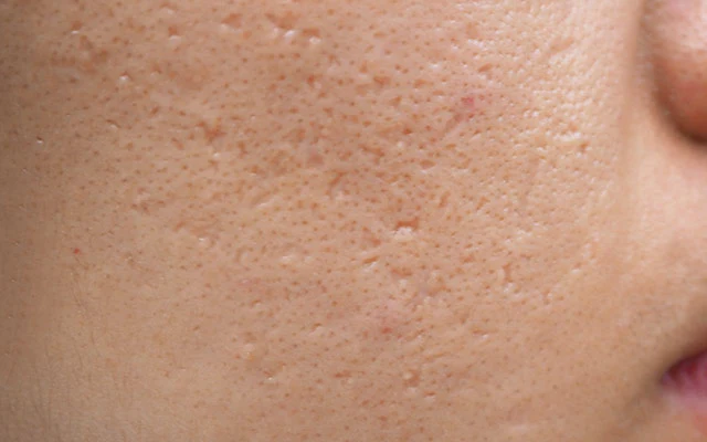 acne scar treatment for ice pick