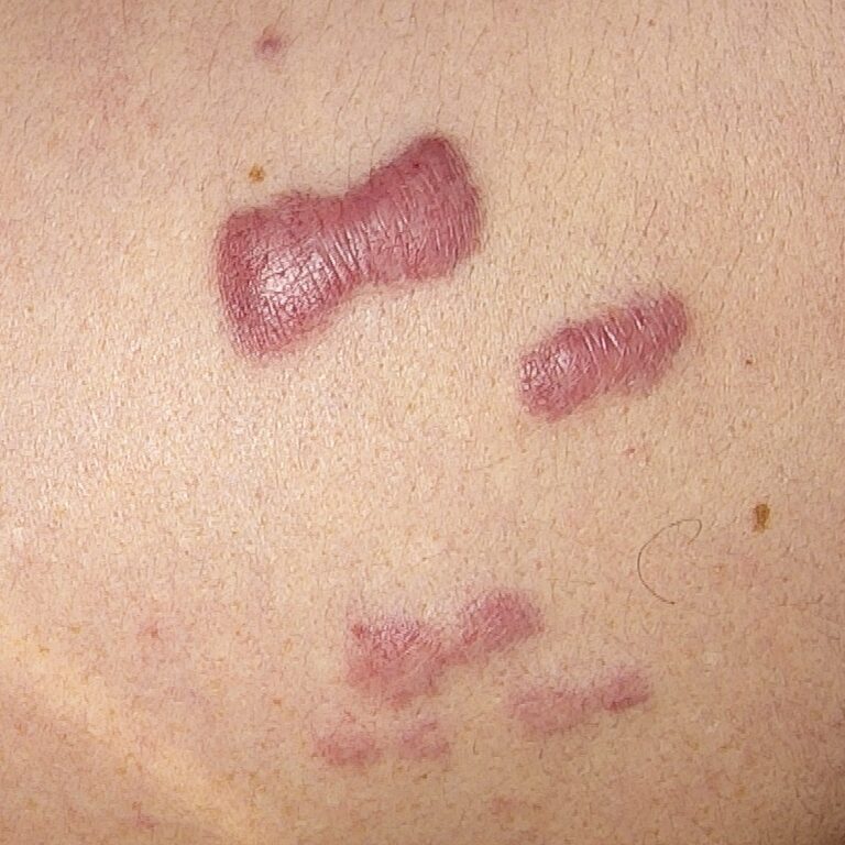 acne scar treatment for keloid scar