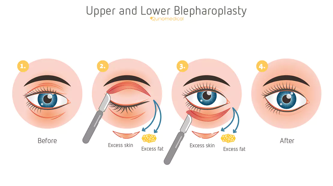 blepharoplasty types